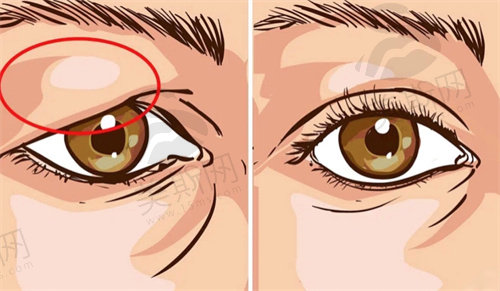  上睑下垂手术和双眼皮手术的回复期区别