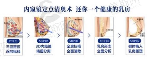 注射式隆胸后能全部取出吗