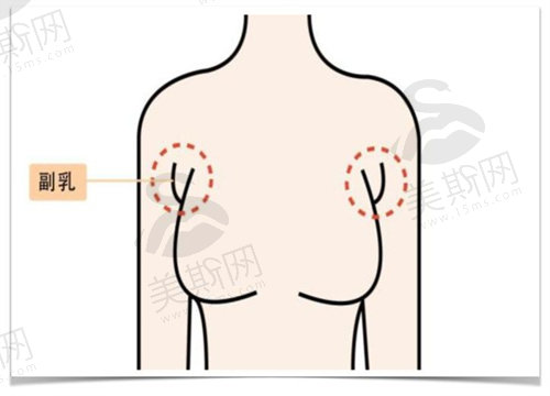 副乳吸脂后有硬块是什么情况