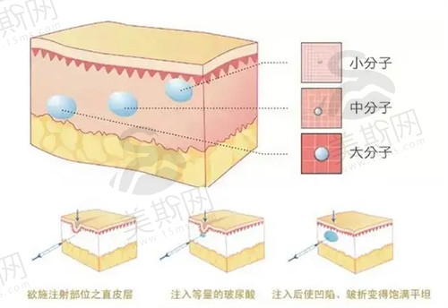 玻尿酸有名品牌