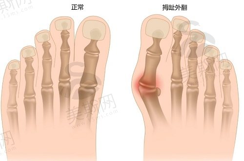 大脚骨外翻微创手术全过程