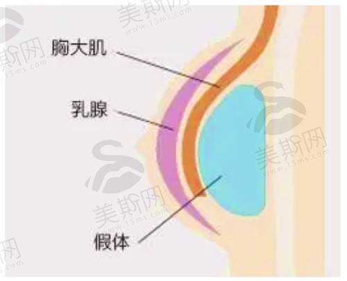 西安画美整形医院王逸涛医生做傲诺拉假体隆胸口碑不错