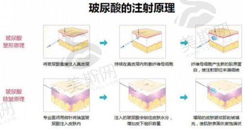 玻尿酸注射原理