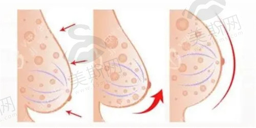 人工韧带乳房提升术能维持多久