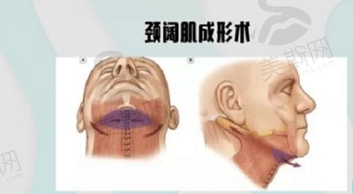 颈阔肌松弛导致双下巴怎么办