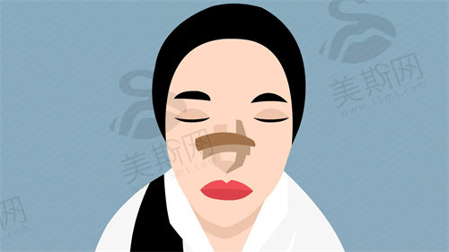 peek鼻基底材料可以长期使用吗