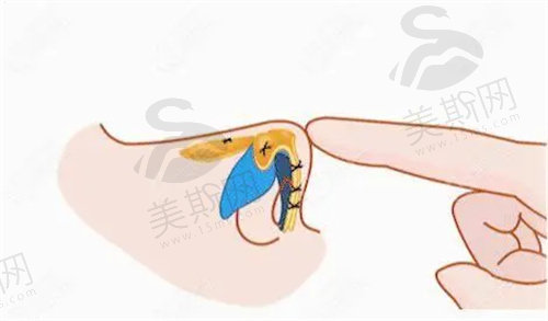 peek鼻基底后期取出很多吗
