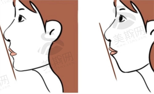 下巴短小后缩是什么原因