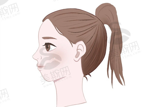 下巴短小后缩是什么原因