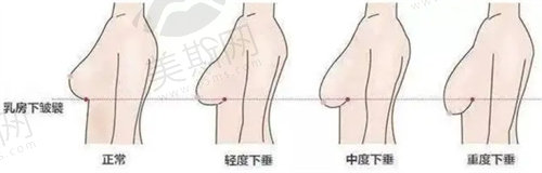 乳房下垂矫正手术适合哪些人群？