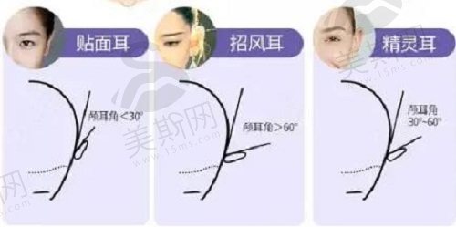 耳基底提升是不是做精灵耳