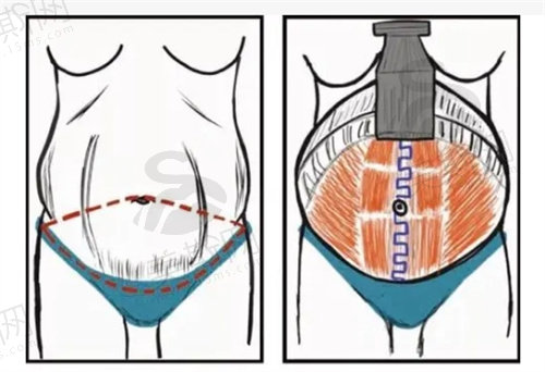 腹壁整形和抽脂区别