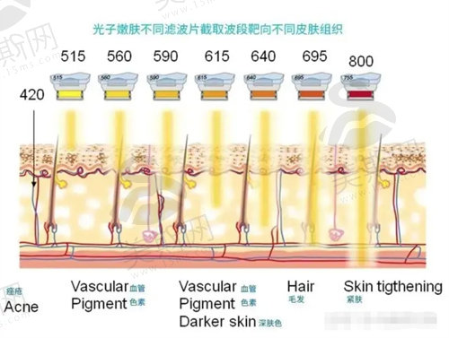 光子嫩肤祛痘印需要几次