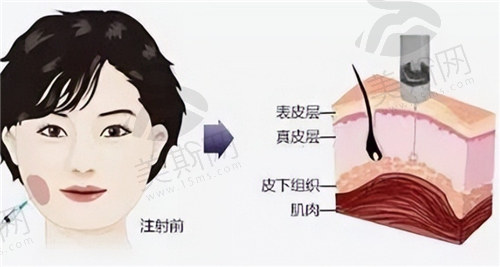 瘦脸-针和溶脂-针的原理及风险