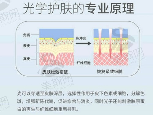 光子嫩肤的功效