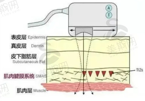 热玛吉和超声炮可以一起打吗