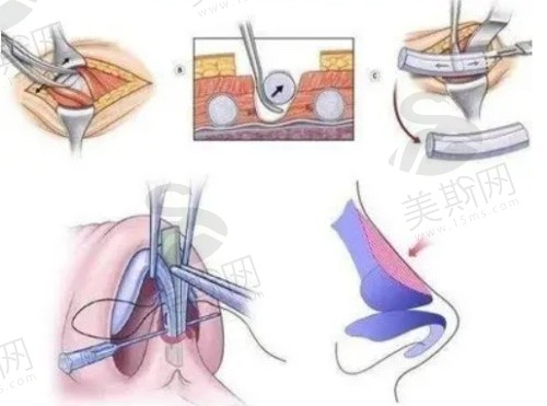 沈阳杏林赵迪半肋骨隆鼻口碑非常好