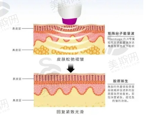 深圳鹏程整形医院热玛吉四代设备正规