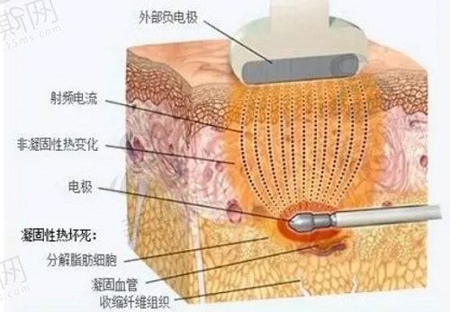 射频溶脂优缺点分析