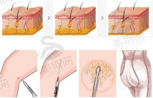 负压吸脂和黄金微雕的区别