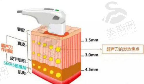 上海首尔 丽格的黄金超声炮技术成熟