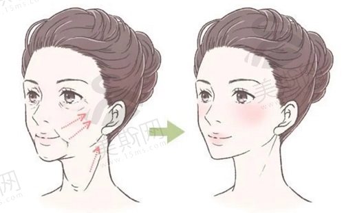 面部提升三件套是什么