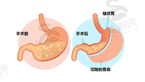 袖状胃切除手术是什么