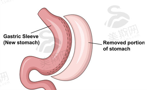 袖状胃手术的利与弊