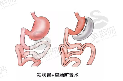 袖状胃手术的优点