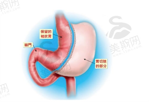 袖状胃切除手术多少钱