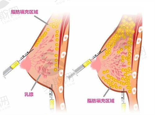 北京禾美嘉医疗美容自体脂肪丰胸技术备受青睐