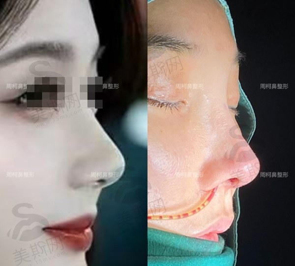成都周柯做鼻修复案 例