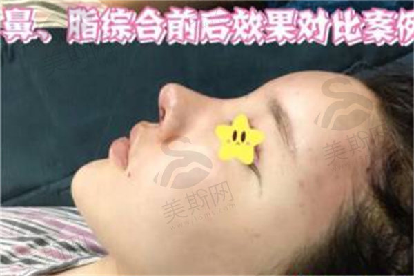 泰国曼谷雨整形医院怎么样