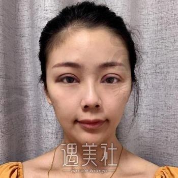 长沙好姑娘医美专家技术实力强大，双眼皮手术案例分享