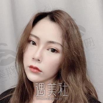 长沙好姑娘医美专家技术实力强大，双眼皮手术案例分享