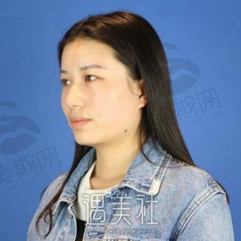 杭州伊瑞医美双眼皮整形案例及价格更新，了解正规性及口碑如何