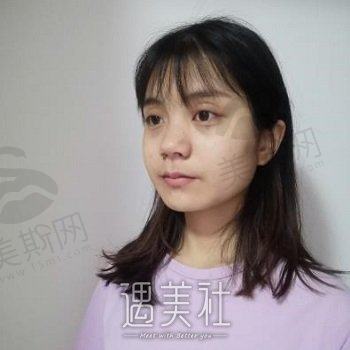 澳尔医疗美容医院合肥分院综合评价及隆鼻手术案例分享