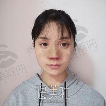 澳尔医疗美容医院合肥分院综合评价及隆鼻手术案例分享