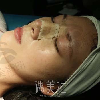 苏州星范医疗美容医院隆鼻技术实力点评及非常新案例分享苏州星范医疗美容医院隆鼻技术实力点评及非常新案例分享