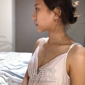 武汉美瑾整形医院怎么样？正规吗？隆胸案例鉴赏