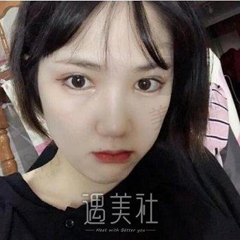 北京美莱整形医院怎么样？资质概况介绍+双眼皮案例