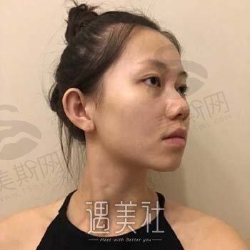 美莱孙明磊做鼻子怎么样？医生简介+隆鼻案例分享