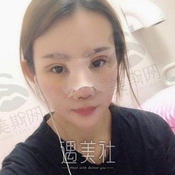 合肥瑞亚国际医美整形医院怎么样？医生名单+玻尿酸填充案例