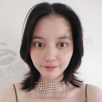 上海整容医生马娟怎么样？医生个人介绍+双眼皮修复案例