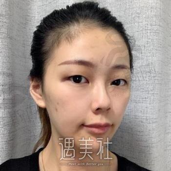 东莞美熙伊美医院是正规医院吗？口碑评价+双眼皮案例分享