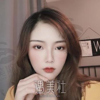 东莞美熙伊美医院是正规医院吗？口碑评价+双眼皮案例分享