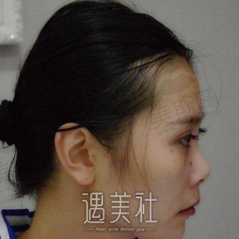 贵阳旭美人整形医院是正规医院吗？概况介绍+隆鼻案例恢复图