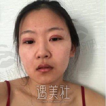 郑州颜初医疗美容医院正规吗？整形技术怎么样？双眼皮案例