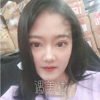 郑州颜初医疗美容医院正规吗？整形技术怎么样？双眼皮案例