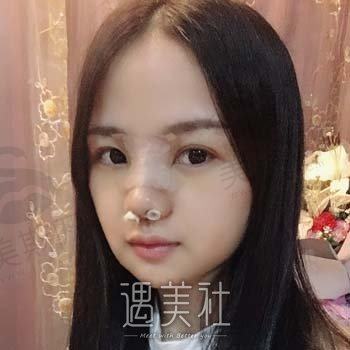 杭州美悦医疗美容正规吗？技术怎么样？隆鼻案例鉴赏